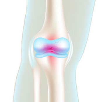 Knee Pain Relief is applied to the injured area