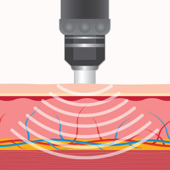 the Acoustic waves induce microtrauma in damaged tissues